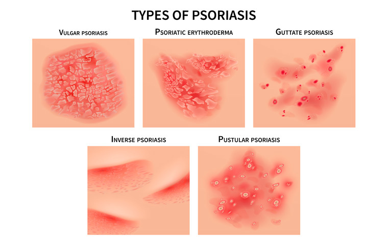 psoriasis-variedades