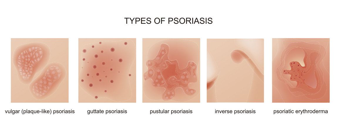 Endemica definicion biolgiai psoriasis