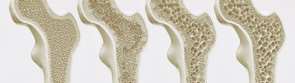 ucbcares-osteoporosis